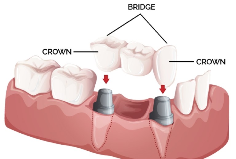 diaries dental clinic crowning and bridging