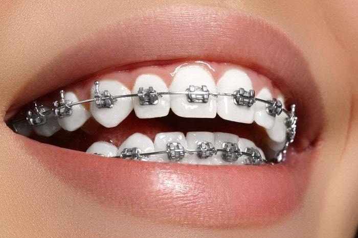 metalic braces by diaries dental clinic