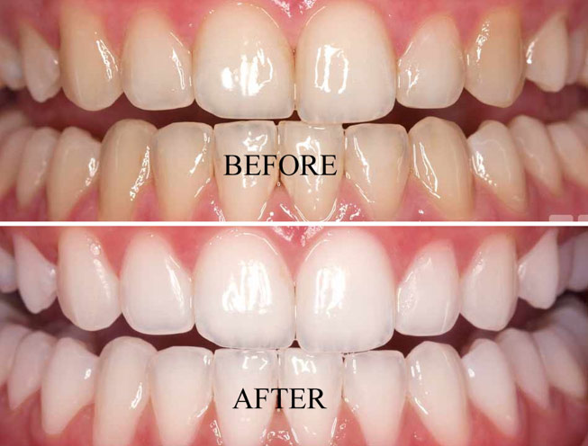 teeth-whitening - diaries Dentalc clinic
